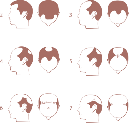 Escolha seu tipo de calvice e faça seu transplante capilar sem sair do Brasil com a Dra. Priscila em Fortaleza no Ceará