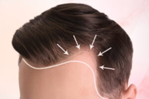 Quais os principais métodos de transplante capilar existentes