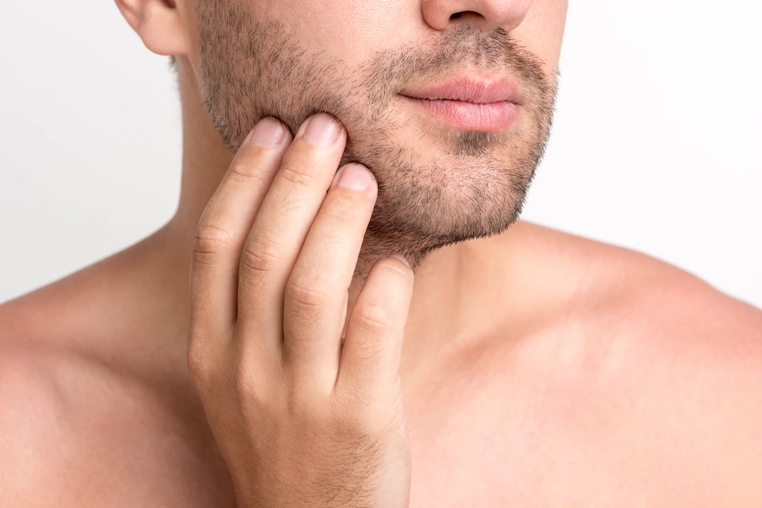 Transplante de Barba Fortaleza | Dra. Priscila Brandão – Medicina Capilar e Estética